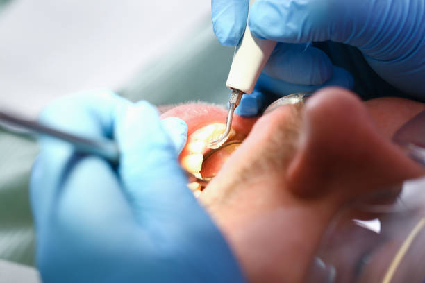 Best Dental Abscess Treatment in Signal Hill, CA