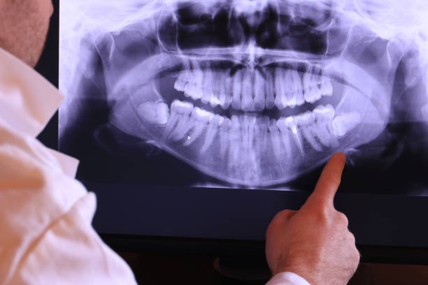 Best Broken or Chipped Tooth Repair in Signal Hill, CA