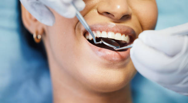 Best Knocked-Out Tooth (Avulsed Tooth) Treatment in Signal Hill, CA